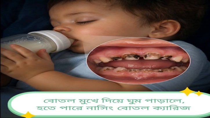 রাতে শিশুর দুধের বোতল মুখে নিয়ে ঘুমানো কেন ক্ষতিকর?